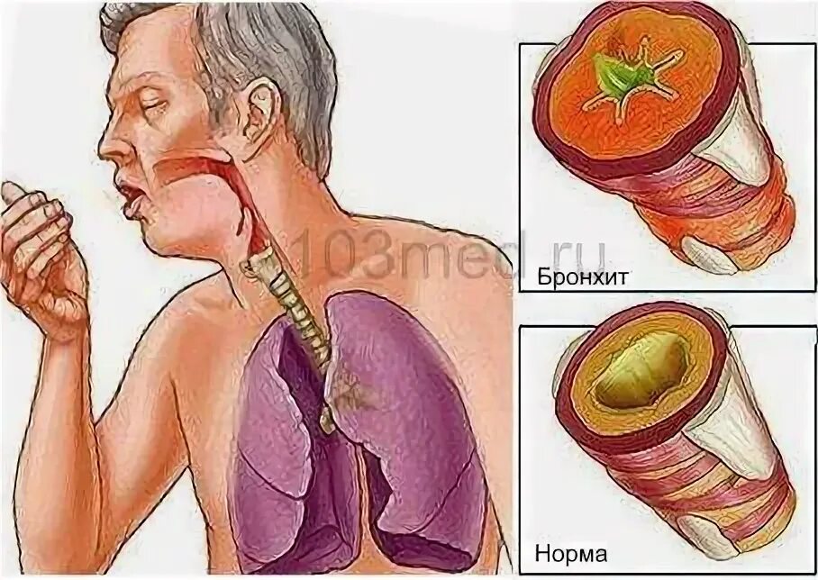 Заразен ли бронхит для окружающих у взрослых. Бронхит памятка. Заразен ли бронхит для окружающих у взрослых. Профилактика бронхита у детей. Механизм развития болезни бронхиальная астма.