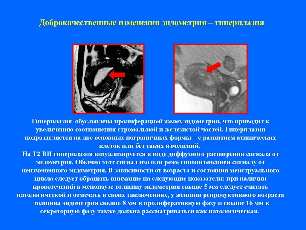 Гиперплазия эндометрия матки мрт. Кистозная гиперплазия эндометрия мрт. Железистая гиперплазия эндометрия мрт. Мрт эндометрия