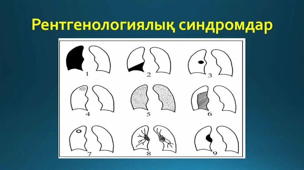 Рентгенологические легочные синдромы. Рентгенологические синдромы патологии легких. Основные рентгенологические синдромы заболеваний органов дыхания. Схемы рентгенологических синдромов заболеваний легких. Рентгенологические синдромы легких