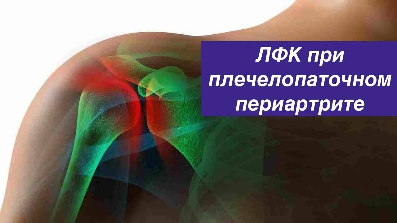 Комплекс упражнений при плечелопаточном периартрите. Плечелопаточный периартрит периартроз. Плечелопаточный периартрит эпикондилит. Плече-лопаточная периартрит. Плечелопаточный периартроз ЛФК.