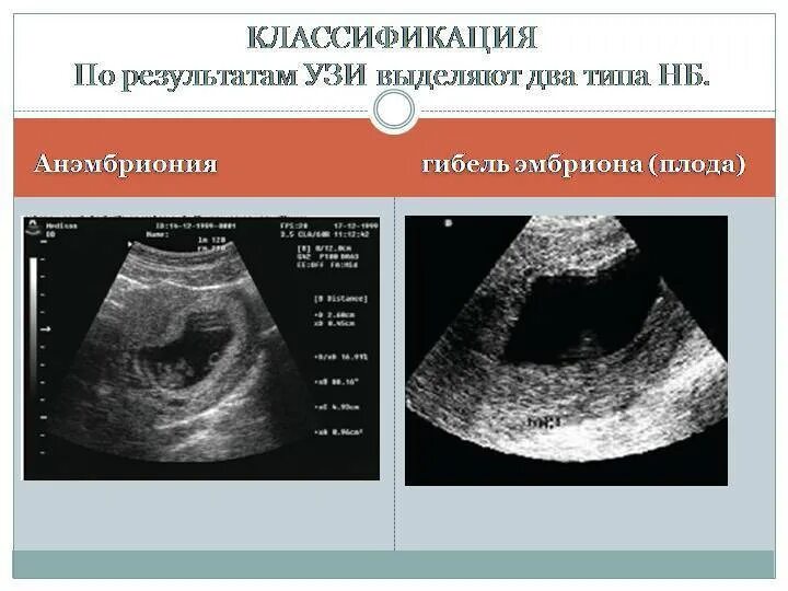 Замершая беременность признаки на ранних сроках. Неразвивающаяся беременность УЗИ. УЗИ неразвивающейся беременности 6 недель. УЗИ при неразвивающейся беременности на ранних сроках. Замершая беременность по типу анэмбрионии.