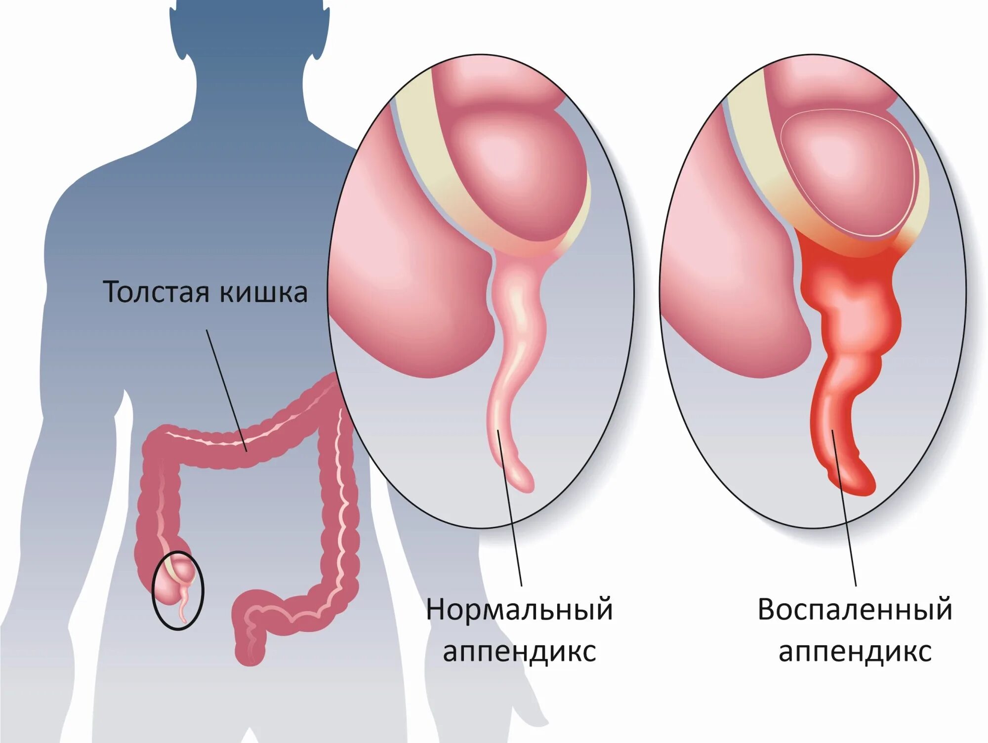 Воспаленный аппендикс. Воспалённый аппендицит. Оренбицит.