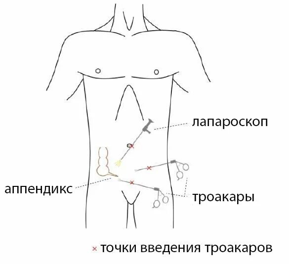 Точки аппендицита. Аппендэктомия лапароскопия доступы. Троакары при лапароскопической аппендэктомии. Доступы при лапароскопической аппендэктомии. Точки при лапароскопической аппендэктомии.