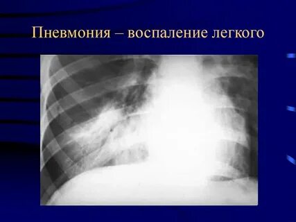 Пневмония 9