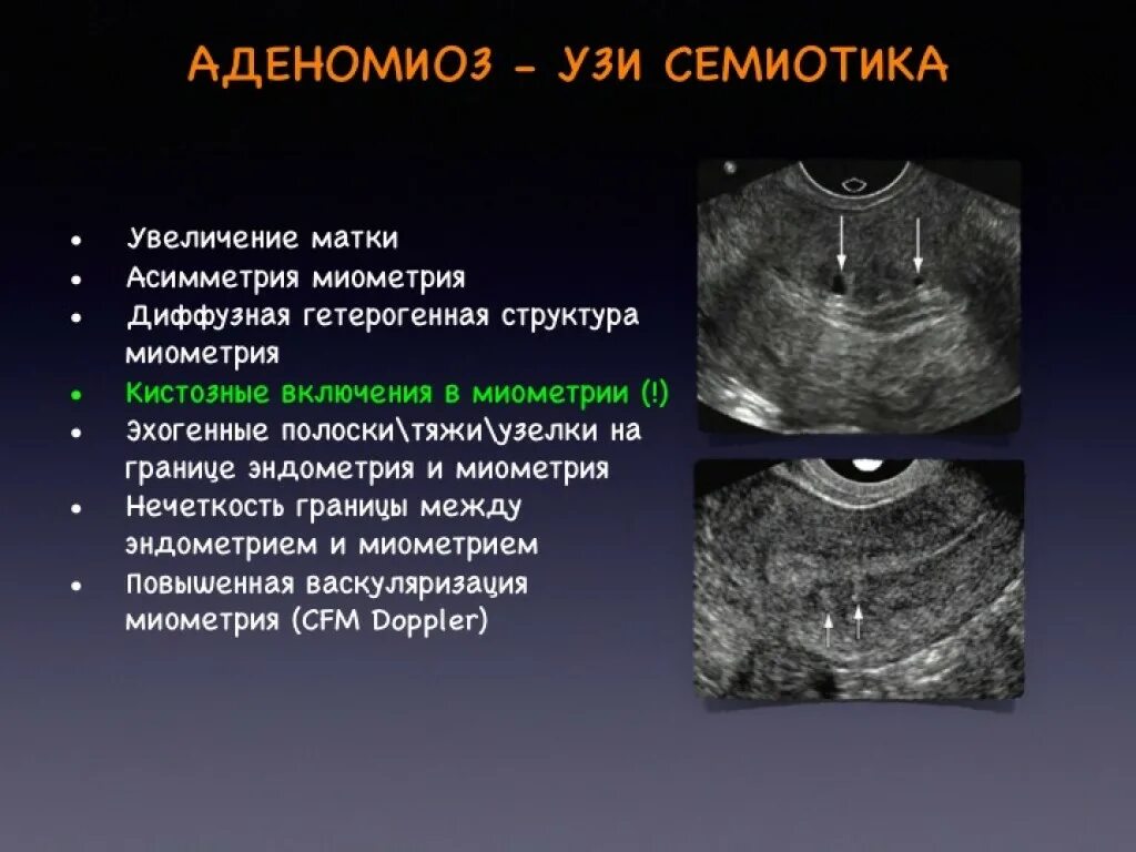 Признаки диффузных изменений миометрия что это. Аденомиоз . Патология эндометрия. Патология эндометрия УЗИ.