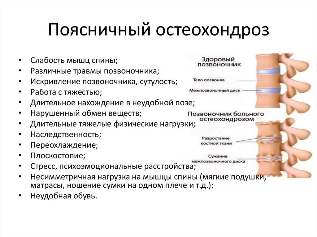 Остеохондроз поясничного отдела позвоночника симптомы