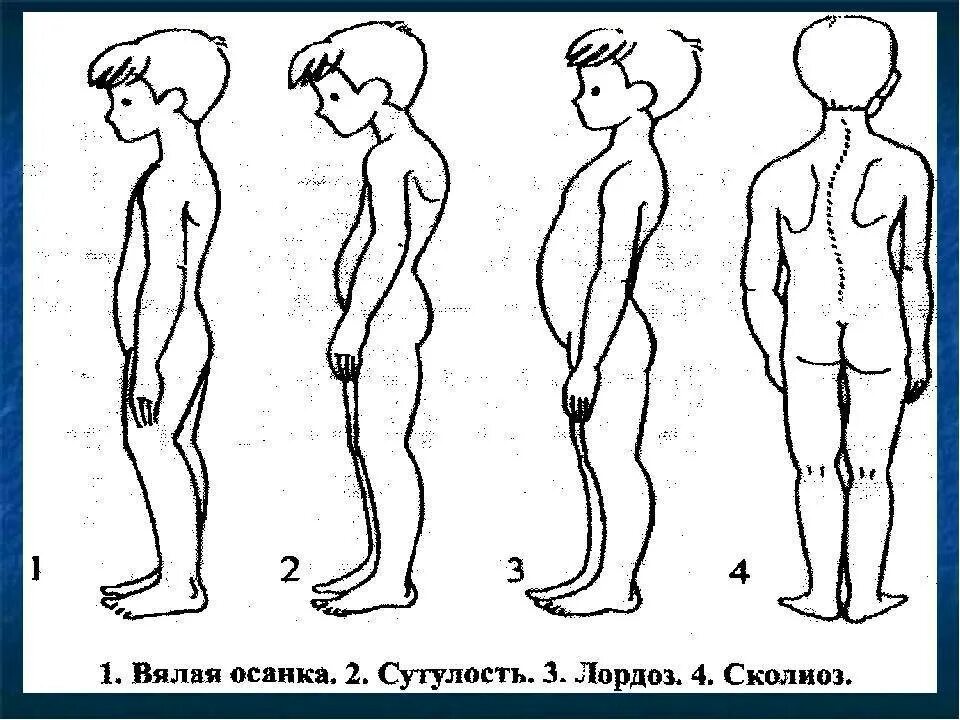 Деформации осанки. Осанка лордоз кифоз сколиоз. нарушение осанки лордоз кифоз сколиоз. деформации позвоночника кифоз лордоз сколиоз. нарушение осанки лордоз у детей.