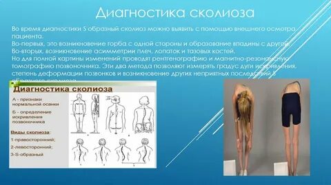 Диагностика сколиоза