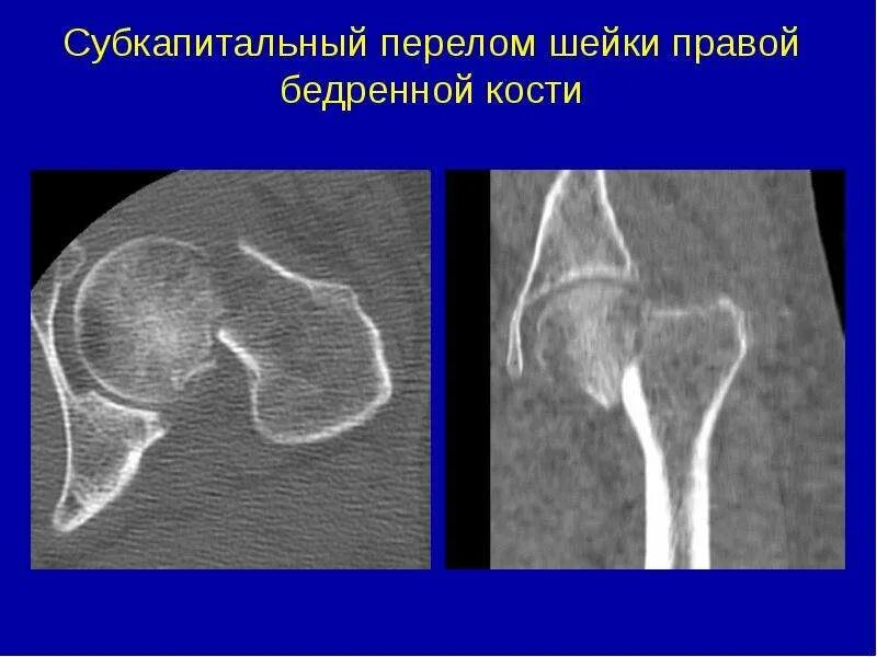 Субкапитальный перелом шейки бедренной кости. Перелом шейки бедра классификация субкапитальный. Перелом головки бедренной кости кт. Перелом шейки бедренной кости кт. Трещина шейки