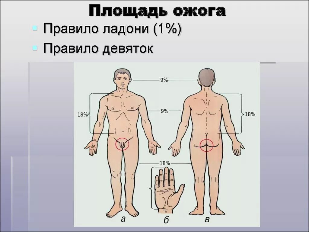 Ожоги проценты поражения. Площадь ожога правило ладони. Площадь ожога правило девяток.