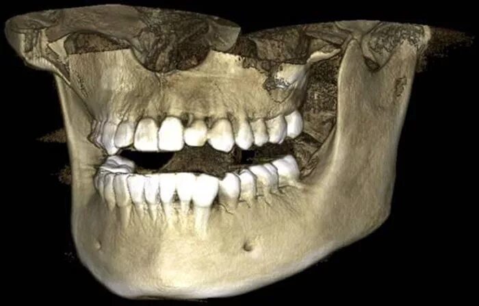 Зд зуб. Кт верхней челюсти и нижней челюсти. 3д КЛКТ челюсти. 3д снимок верхней и нижней челюсти.