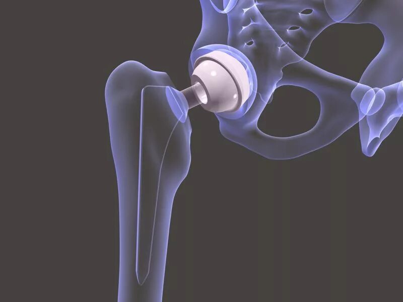 Операция шейки бедра стоимость. Эндопротезирование тазобедренного сустава. Эндопротез кости бедра. Тазобедренный эндопротез Зиммер. Тазобедренный эндопротез Stryker.
