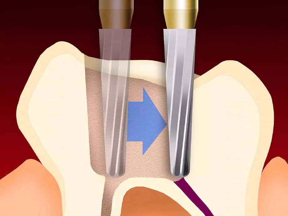 Твердосплав эндодонтия. Эндодонтия корневых каналов. Эндодонтия в стоматологии. Препарирование корневого канала
