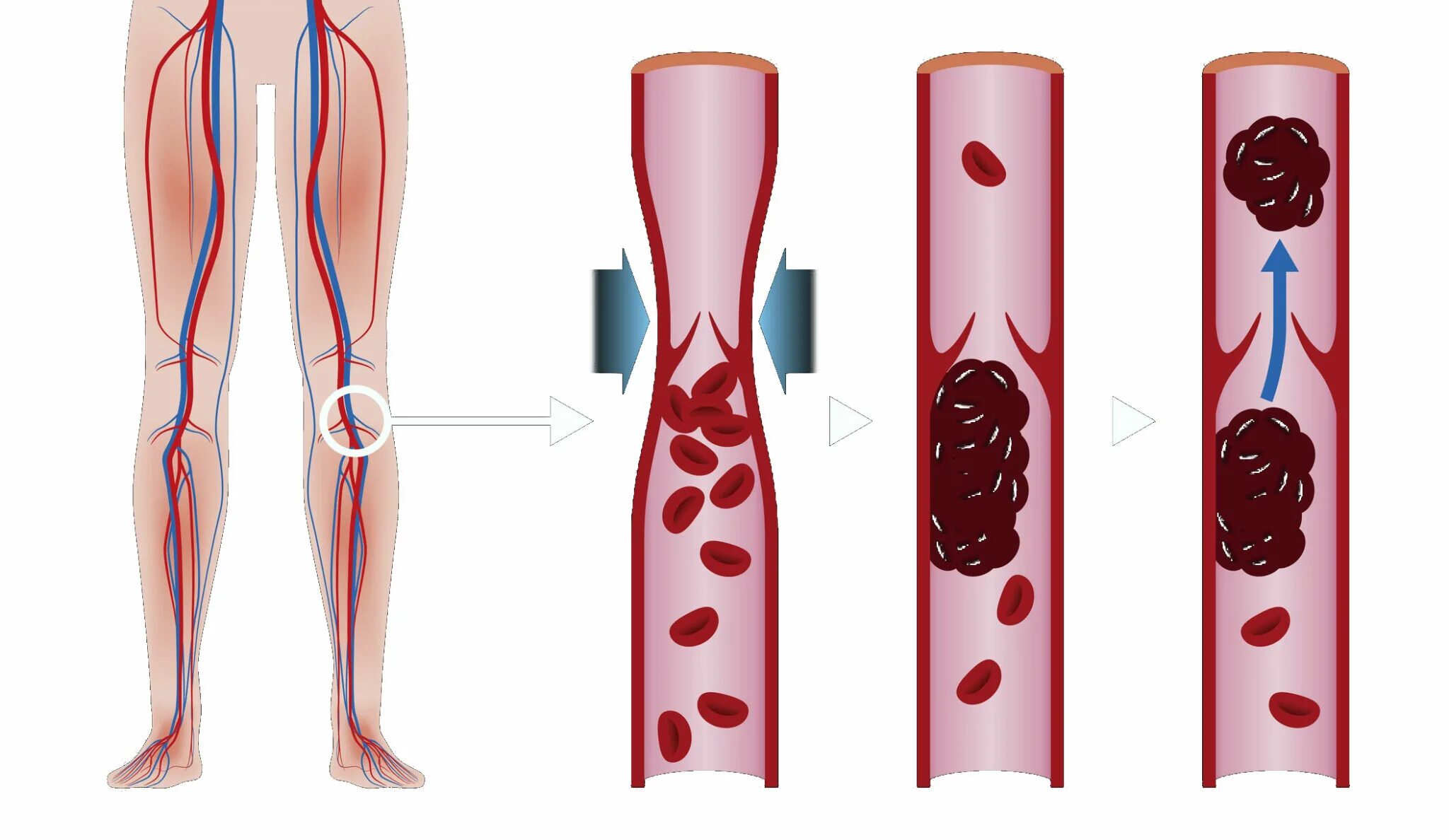 Тромб в артерии симптомы. Тромбофлебит вен нижних конечностей. Острый тромбоз глубоких вен клиника. Тромбофлебит глубоких вен клиника. Тромбоз вен нижних конечностей симптомы.