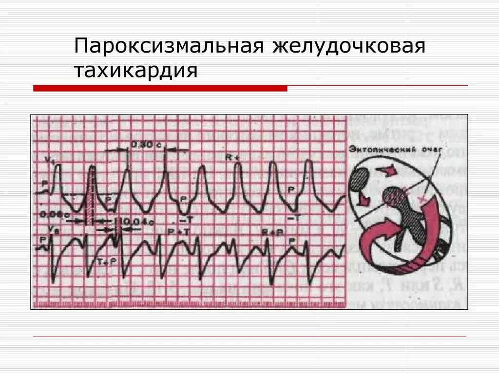 Желудочковая тахикардия на экг. Пароксизмальная желудочковая тахикардия на ЭКГ. ЭКГ при желудочковой пароксизмальной тахикардии. ЭКГ признаки пароксизмальной желудочковой тахикардии. Пароксизмальная желудочковая на ЭКГ.