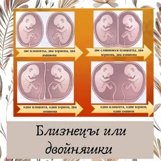 Многоплодная монохориальная беременность