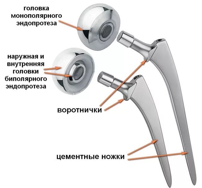 Однополюсный биполярный эндопротез тазобедренного сустава. Типы протезов тазобедренного сустава. Анатомия протеза тазобедренного сустава. Эндопротез тазобедренного сустава строение. Эндопротезирование тазобедренного отзывы пациентов