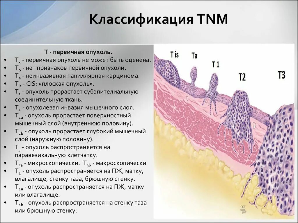 G1 опухоли. Опухоль мочевого пузыря TNM. Папиллярная уротелиальная карцинома. TNM гистология опухоли. Классификация TNM мочевой пузырь.