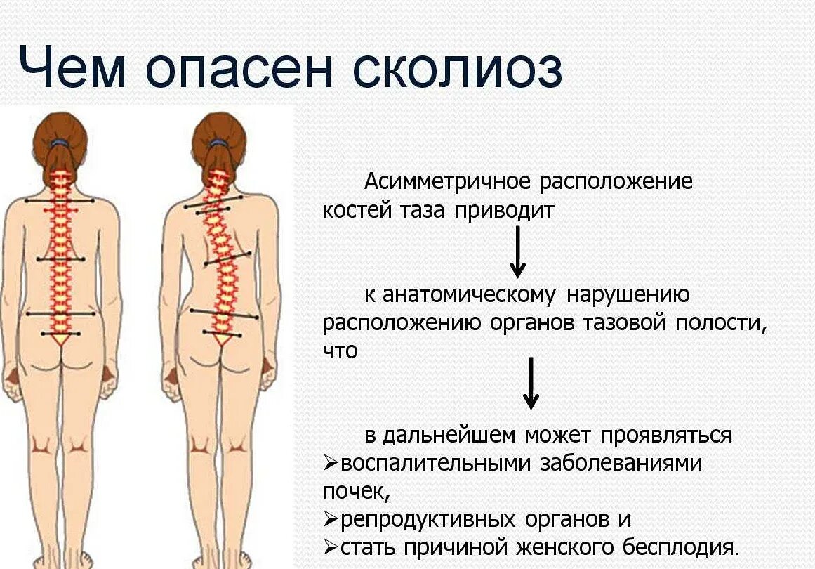 Что означает сколиоз
