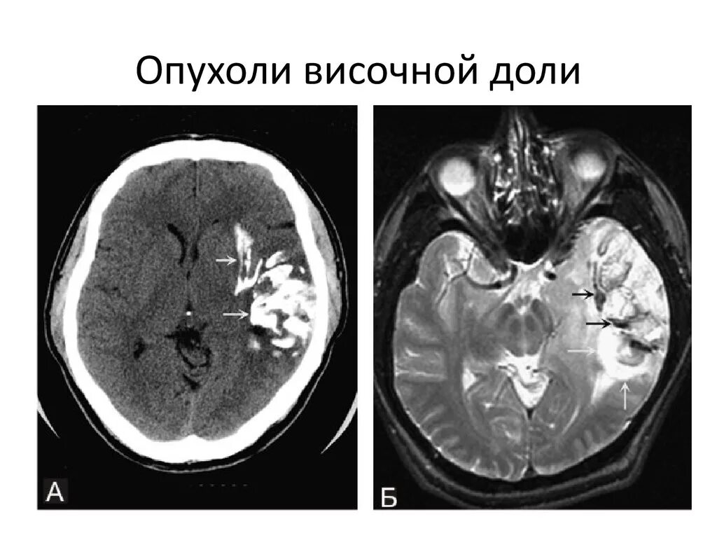 Опухоли теменной. Глиома височной доли мрт. Глиома височной доли кт. Олигодендроглиома мрт.