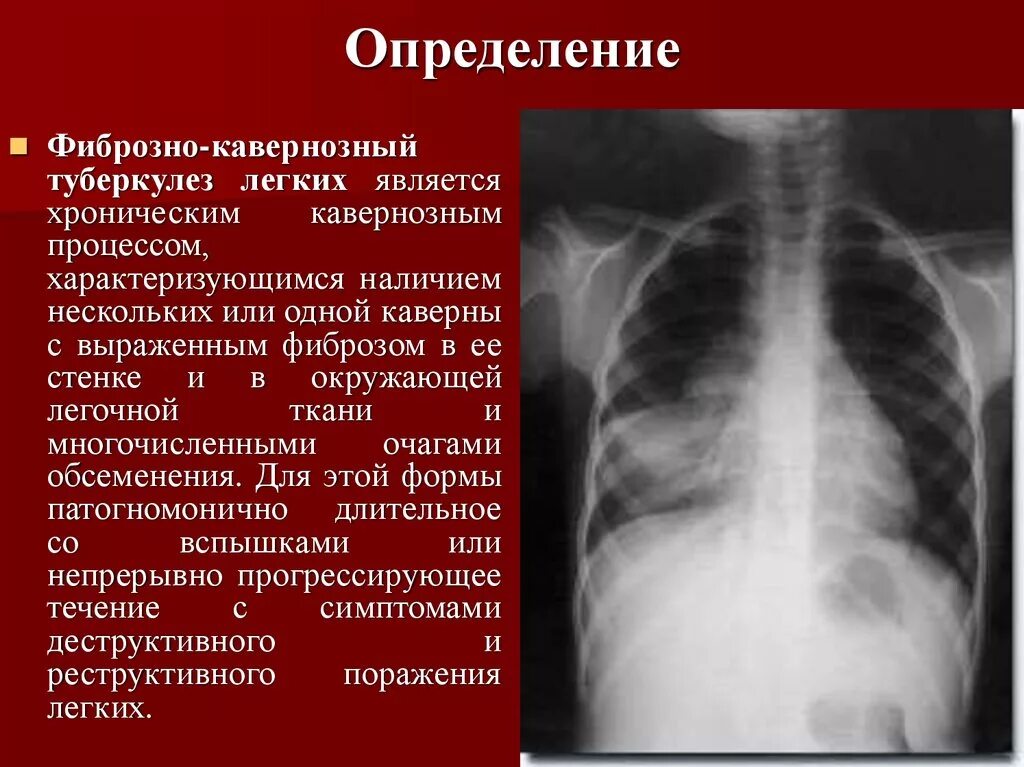 Дать определение легких. Фиброзно-кавернозный туберкулез легких характеризуется. Рентгенологические признаки фиброзно-кавернозного туберкулеза. Фиброзно кавернозный туберкулез синдромы. Каверна туберкулез рентген.