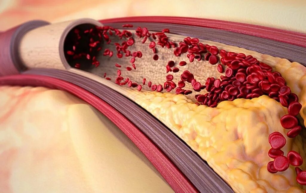 Атеросклеротическая бляшка. Кровяные бляшки в сосудах. Кровеносные сосуды от холестериновых бляшек;. Атеросклеротические бляшки в сосудах. Как очистить сосуды от холестериновых тромбов