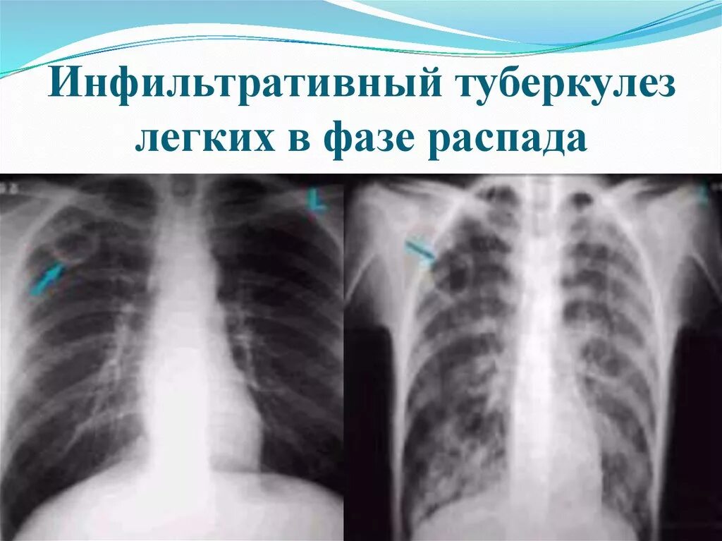 Инфильтративный туберкулез рентгенография. Инфильтративный туберкулез с6. Инфильтративный туберкулез s1 s2. Инфильтративный туберкулез легких s2.