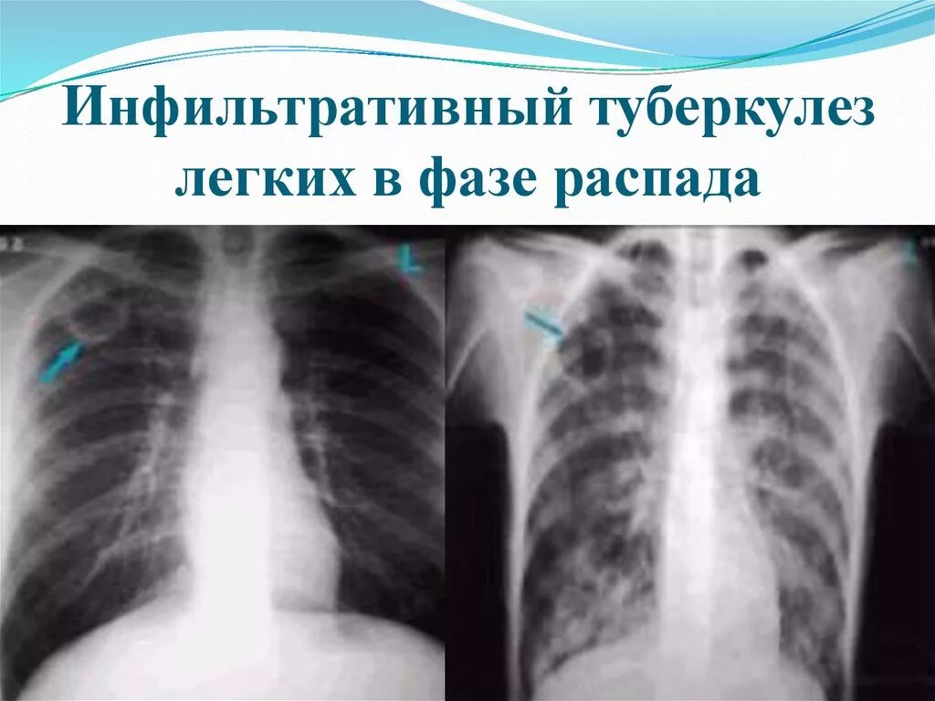 Инфильтративного в фазе распада