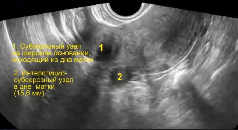 Субсерозная миома матки УЗИ. Интерстицио субсерозная миома матки что это. Субмукозная миома матки УЗИ. Узи при миоме матки на какой день