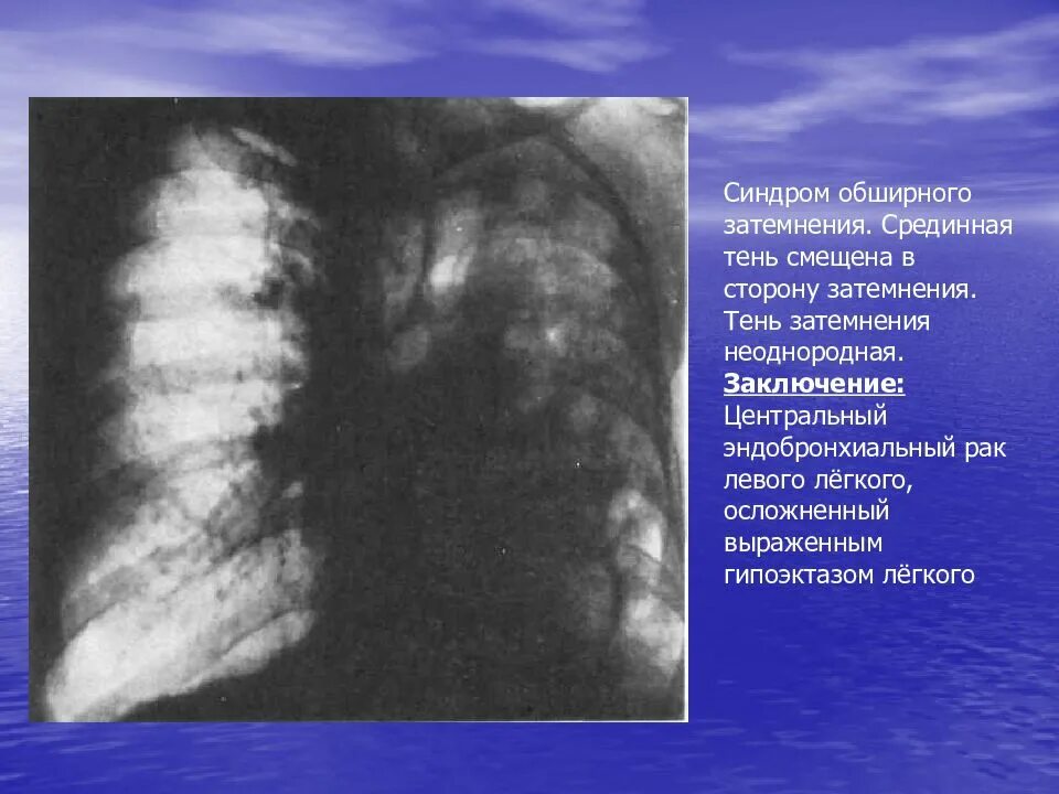 80 поражения легких. Синдром обширного затемнения. Затемнение правого легкого. Затемнение левого легкого.