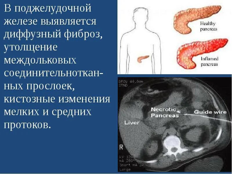 Диффузное увеличение поджелудочной железы. Изменения поджелудочной железы. диффузные изменения поджелудочной железы. диффузно-дистрофические изменения поджелудочной железы. умеренные диффузные изменения паренхимы поджелудочной железы.