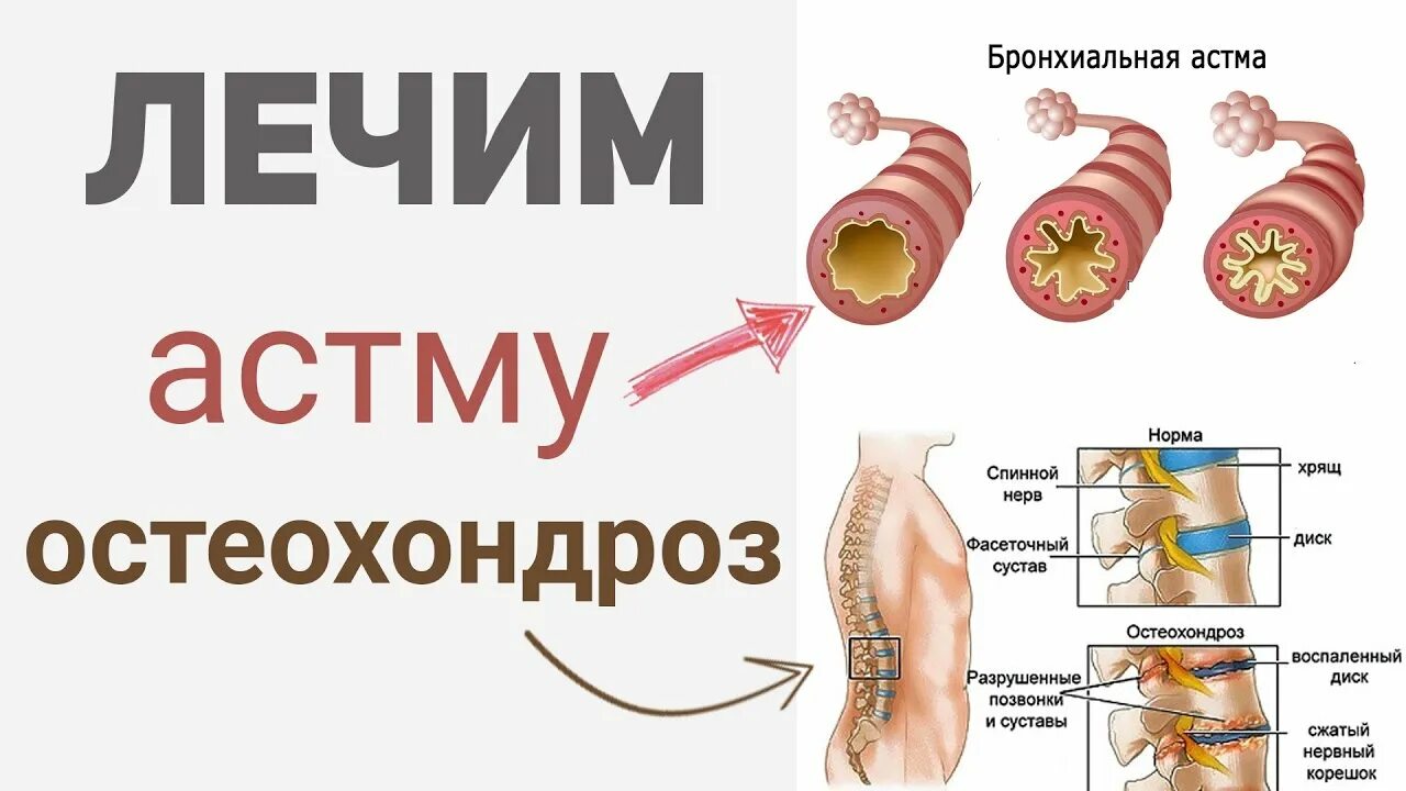 Как лечат астму у взрослых. Остеохондроз и бронхиальная астма. астма и остеохондроз. вылечил астму. астма и лишний вес.