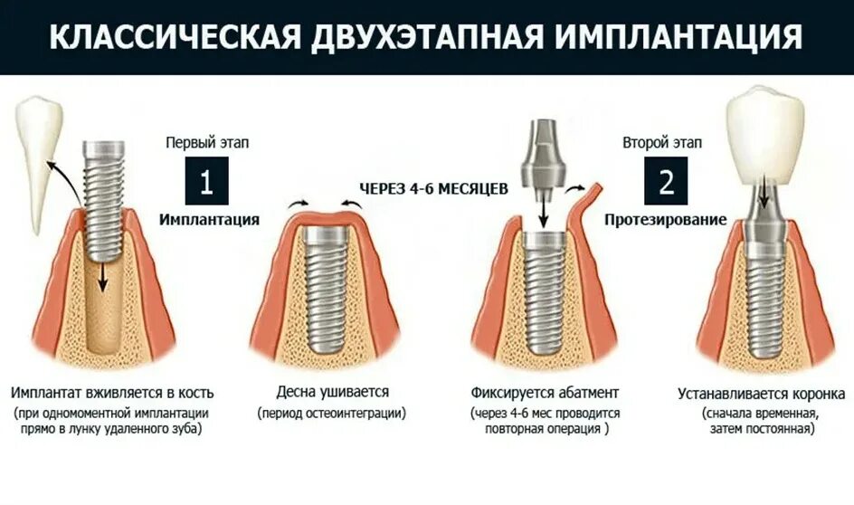 Этапы имплантации зубов