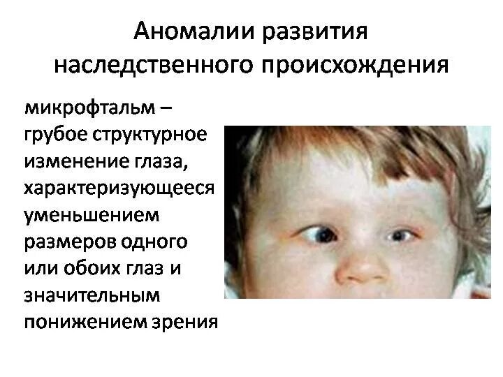 Наследственные пороки развития. Врожденные патологии развития. Врожденные пороки и аномалии развития. Наследственные заболевания зрения