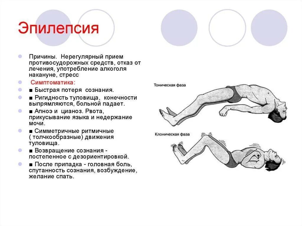 Эпилепсия глаз