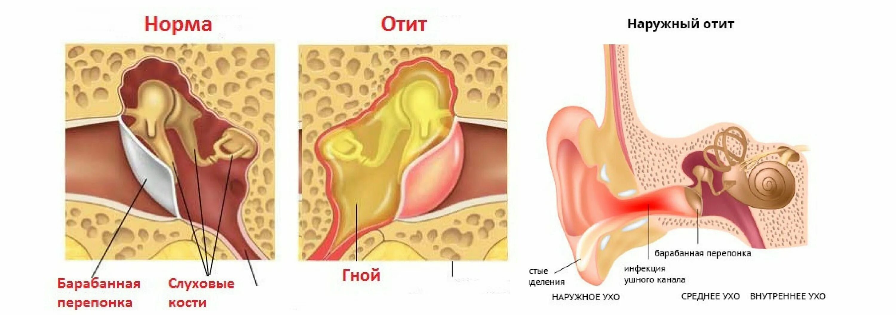 Воспаление канала у мужчин. Туботимпанальный Гнойный отит. Наружный отит барабанная перепонка. Воспаление наружного слухового прохода (отит). Отит вид барабанной перепонки.