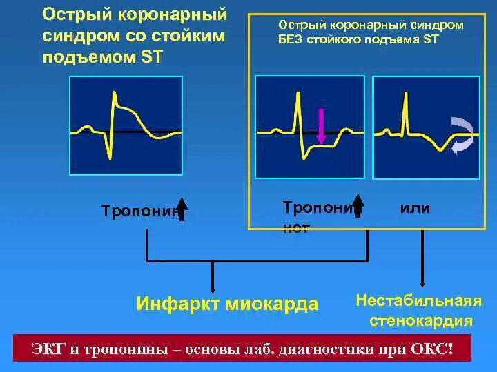 Тесты с ответами острый коронарный синдром. ИБС острый коронарный синдром без подъема сегмента St. ЭКГ при Окс с подъемом сегмента St. ЭКГ при инфаркте миокарда без подъема сегмента St. ЭКГ при инфаркте миокарда с подъемом сегмента St.