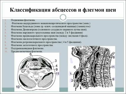Разрез абсцесса
