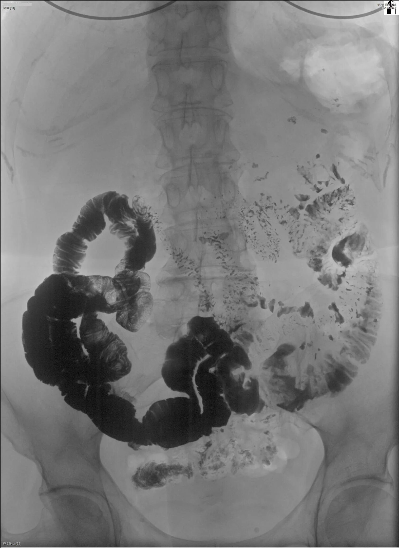 Микровезикулярный полип толстой кишки. Рентген кишечника Пассаж барием. Толстокишечная непроходимость рентген Пассаж бария. Рентген энтерография тонкого кишечника.