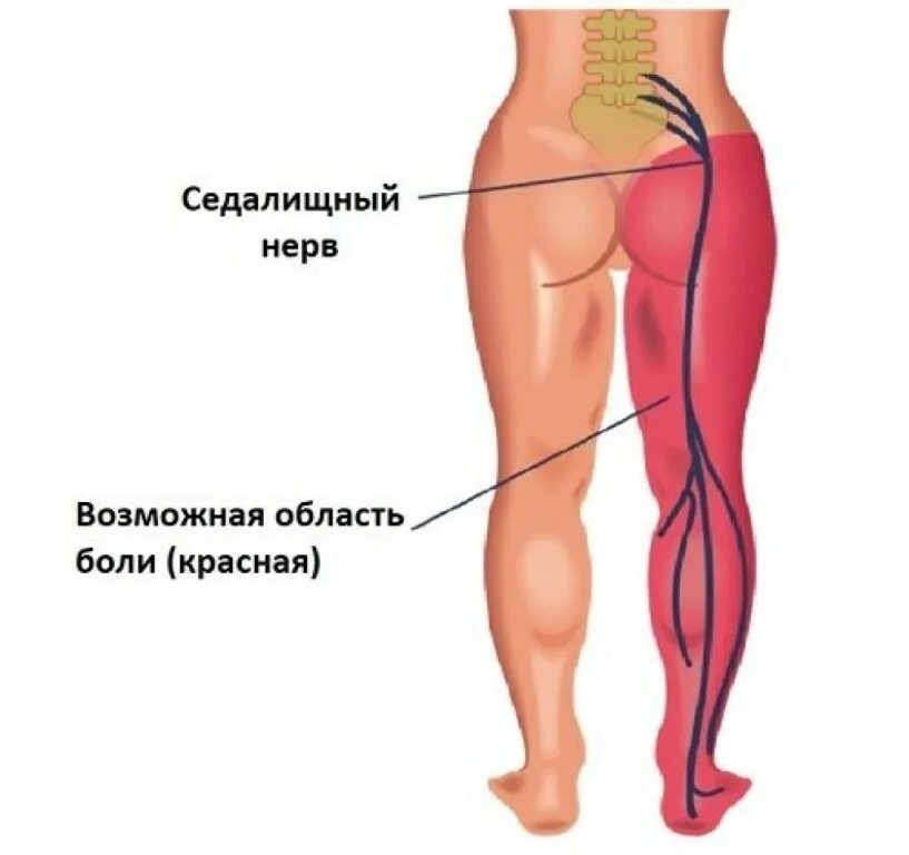 Седалищный нерв где находится симптомы. Седалищный нерв схема. ишиас воспаление седалищного. седалищный нерв схема расположения. седалищный нерв иррадиация боли.