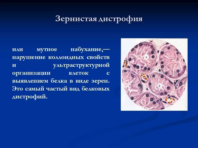 Зернистая белковая дистрофия микроскопия. Вакуольная гидропическая дистрофия гистология. Гидропическая дистрофия гепатоцитов гистология. Зернистая дистрофия эпителия почечных канальцев.