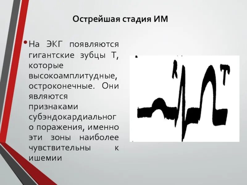 Острые зубцы на экг. Высокий остроконечный зубец т на экг. заостренный зубец т на экг. экг остроконечный остроконечный зубец т. признаки коронарного зубца т на экг.