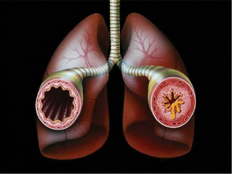 Bronchial asthma