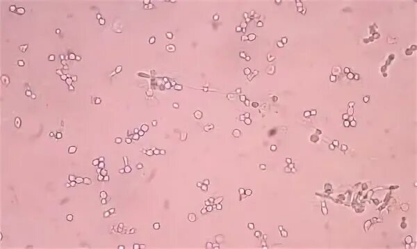 Дрожжевые клетки в моче повышены. Мицелий дрожжевого грибка в моче. Дрожжеподобные клетки в моче. Грибы в моче под микроскопом. Дрожжи в моче микроскопия.