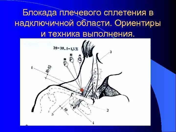 Блокада техника выполнения. Проводниковая блокада плечевого сплетения по Соколовскому. Проводниковая анестезия плечевого сплетения. Показания для блокад надключичного плечевого сплетения. Осложнения межлестничной блокады плечевого сплетения.