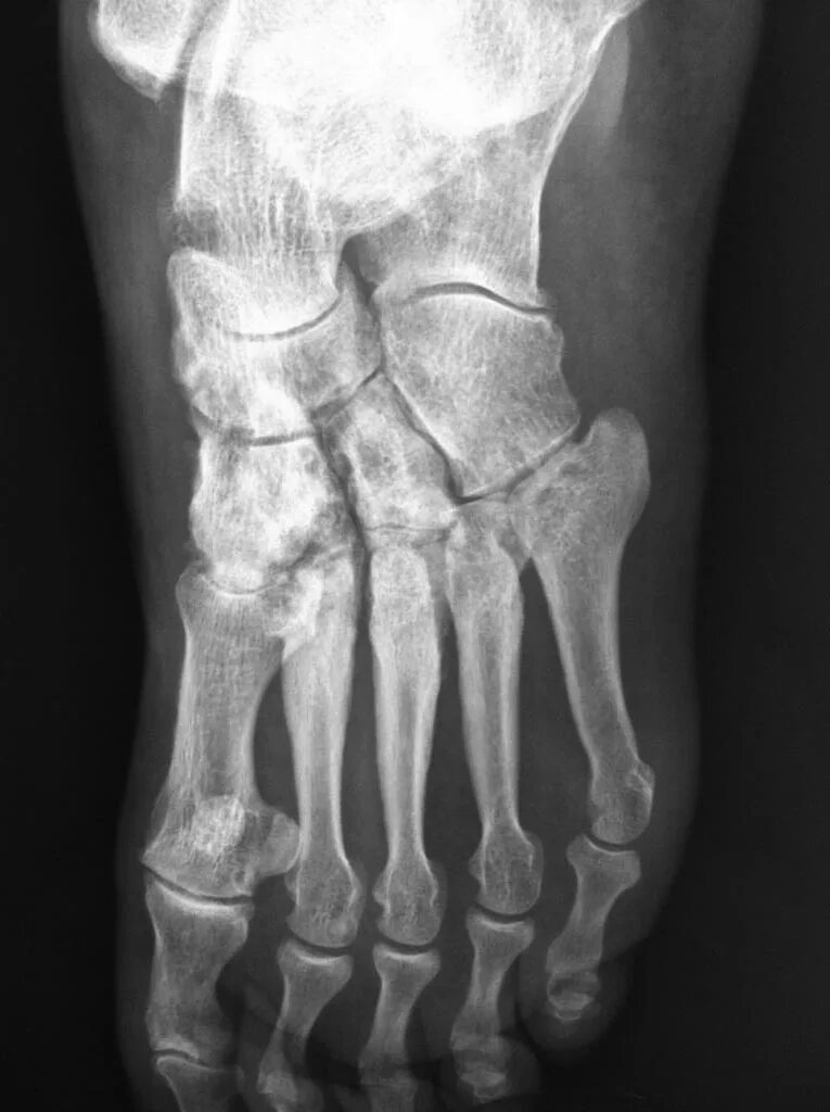 остеохондропатия келлера 2. асептический некроз таранной кости кт. асептический некроз костей стопы. остеохондропатия ладьевидной кости стопы. асептический некроз костей стопы.