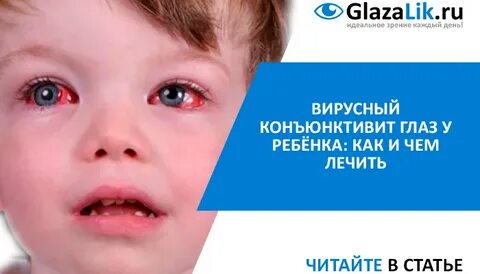 Симптомы конъюнктивита у детей 2