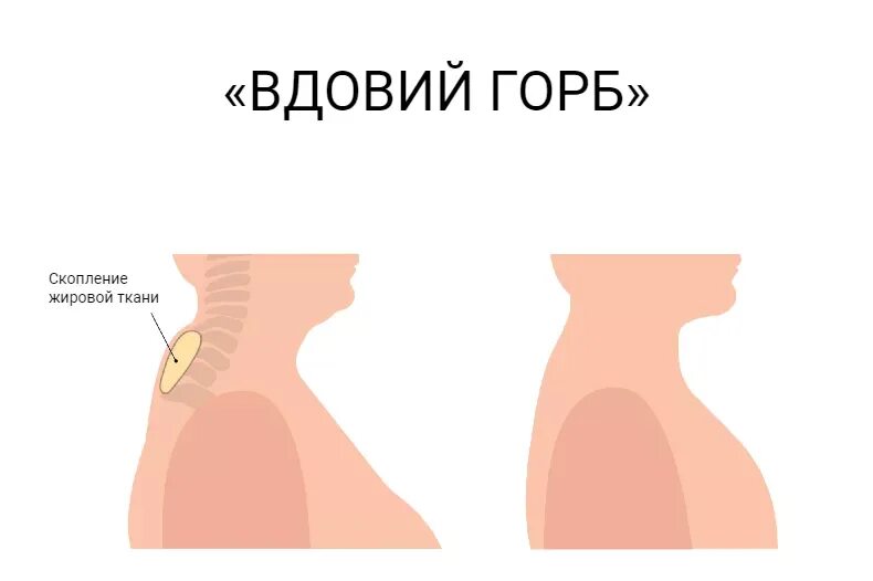 Почему появляется горбик. Почему появляется горбик