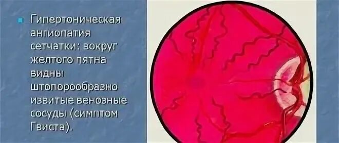 Ангиосклероз сосудов сетчатки. Ангиопатия сосудов глазного дна мкб 10. Гипертонический ангиосклероз. Гипертонический ангиосклероз сетчатки.