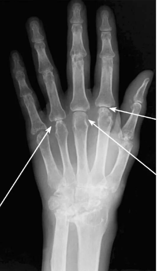 Околосуставной остеопороз. Околосуставной остеопороз кистей рентген. Ревматоидный артрит рентген кистей околосуставной остеопороз. Периостит пальца кисти рентген. Пластина в пальце